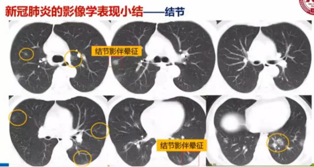AI助力疫情防控，專利為其保駕護航！