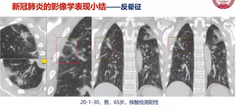 AI助力疫情防控，專利為其保駕護航！